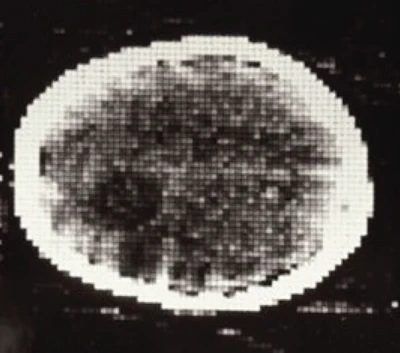 The first clinical CT scan, with brain tumor visible as darker blob.