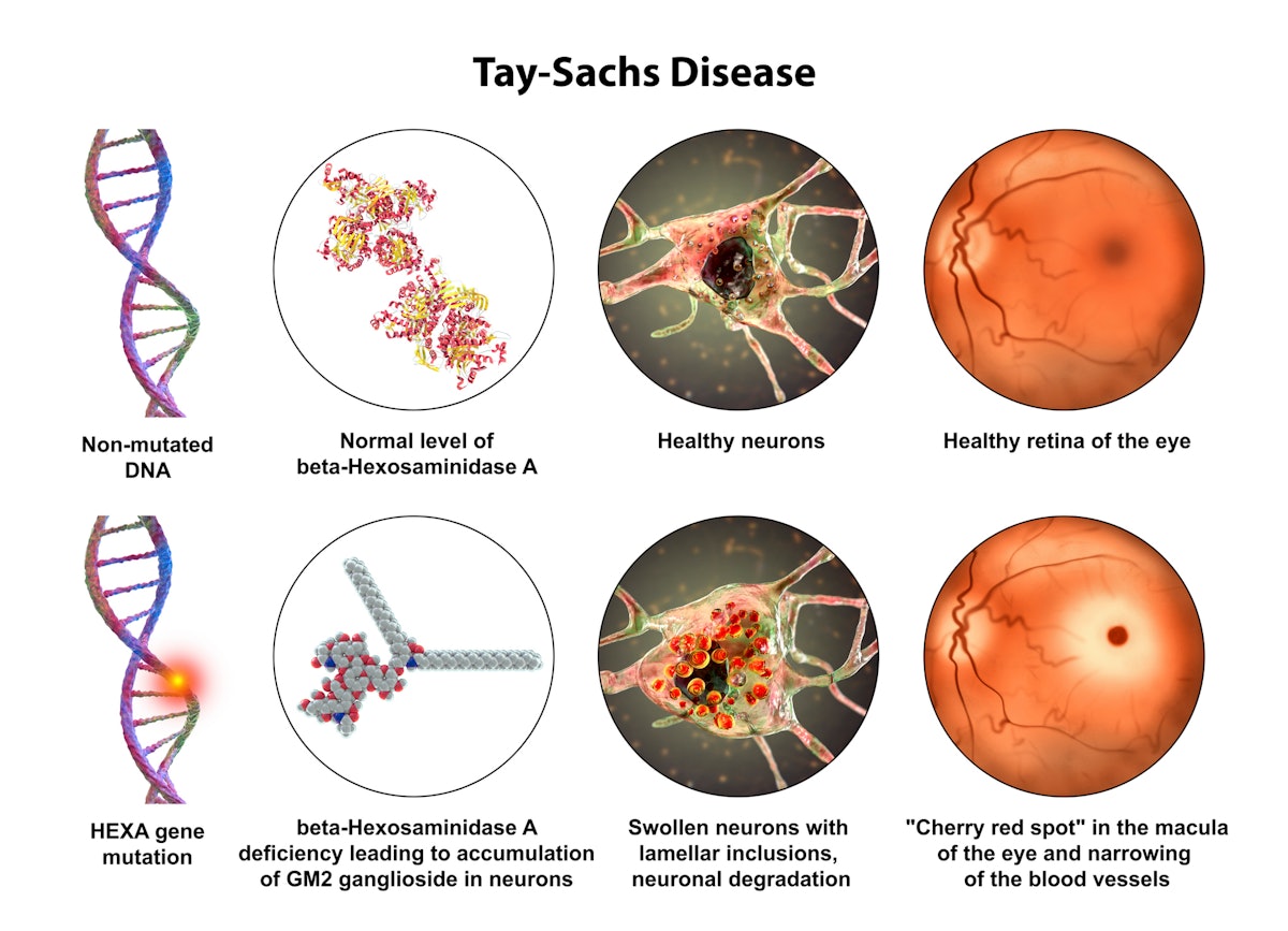 2 Kids Get First Gene Therapy For Tay-Sachs Disease | Manufacturing  Business Technology