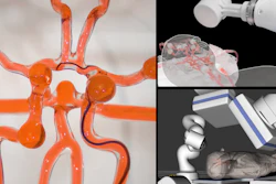 MIT engineers developed a telerobotic system to help surgeons remotely treat patients experiencing stroke or aneurysm. With a modified joystick, surgeons may control a robotic arm at another hospital to operate on a patient.