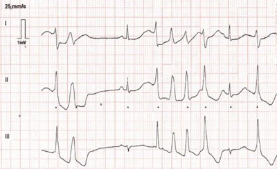 Rhythm strip showing short runs of torsade de pointes and a markedly prolonged corrected QT interval.