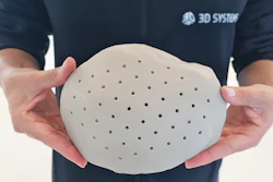 3d Systems Cranial Implant