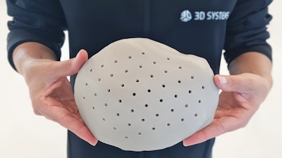 3d Systems Cranial Implant