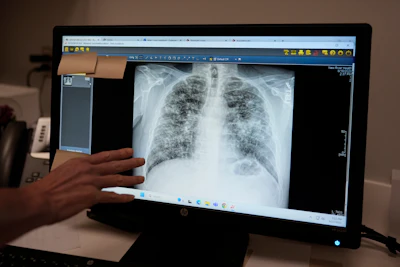 Lisa Emery, director of the New River Health Association Black Lung Clinic, examines a chest X-ray showing progressive massive fibrosis, the most complicated form of black lung, at the center on Sept. 23, 2025, in Oak Hill, W.Va.